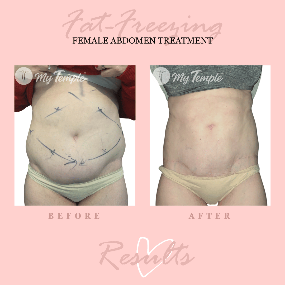 Tummy tuck Amelia website.png