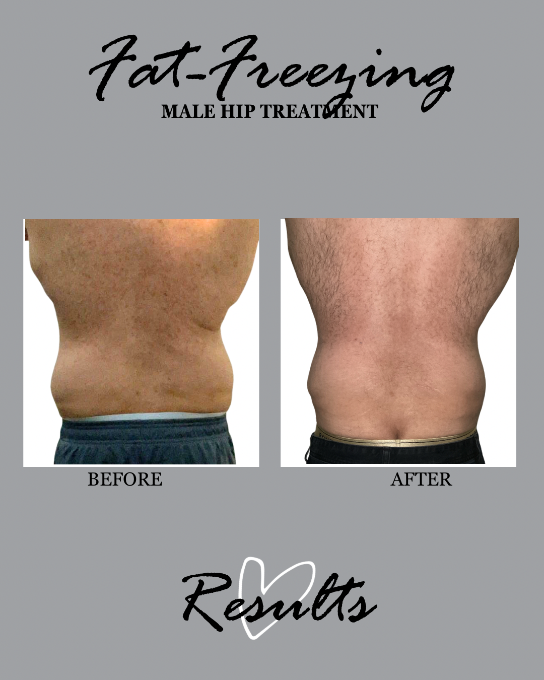FAT FREEZING ON MENS HIPS