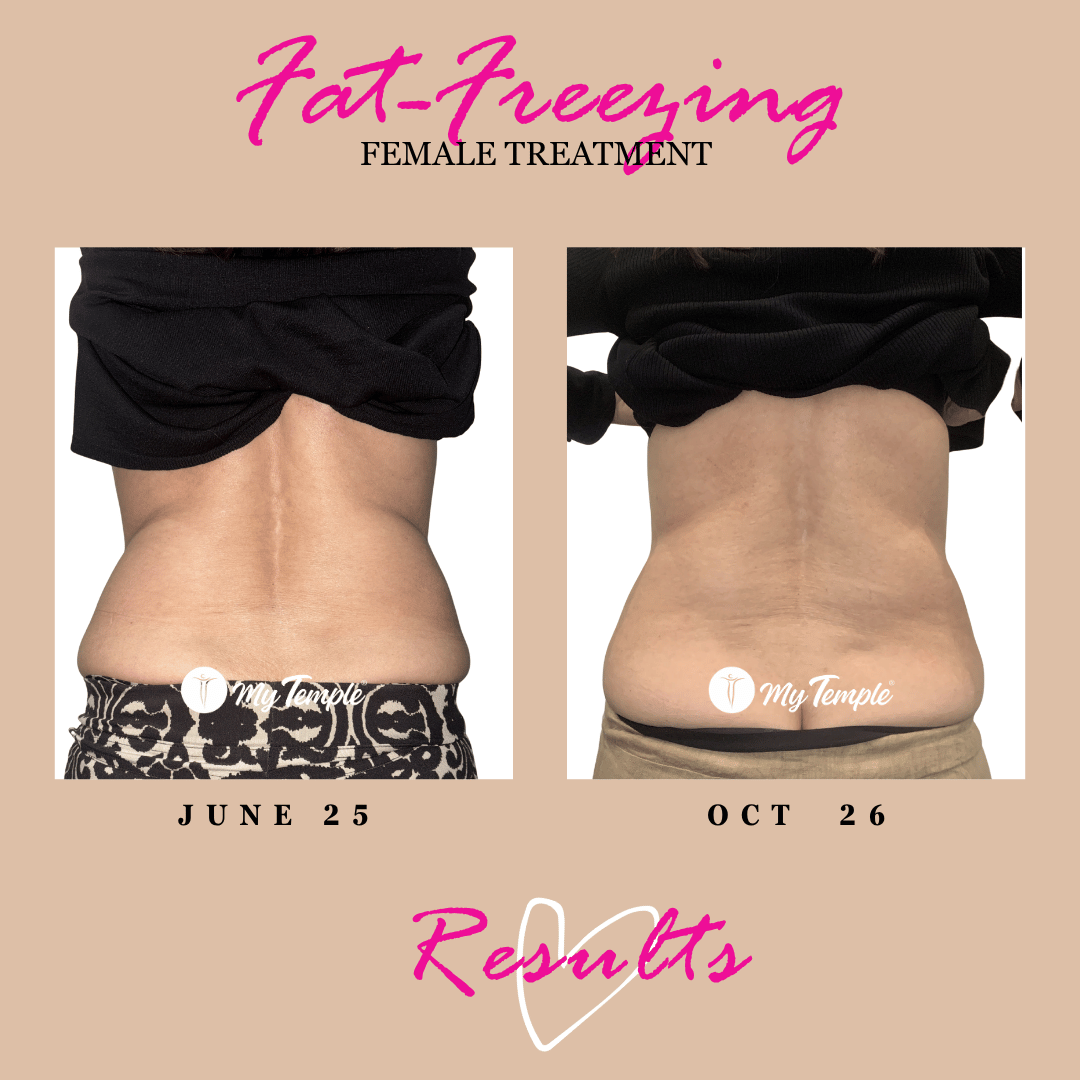 fat freezing results on hips