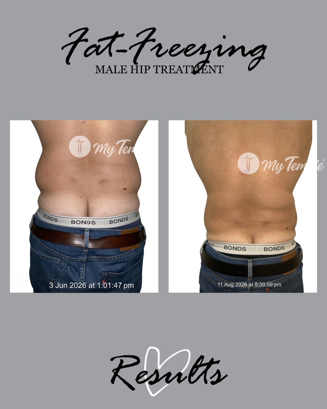 mans hips fat freezing on love handles