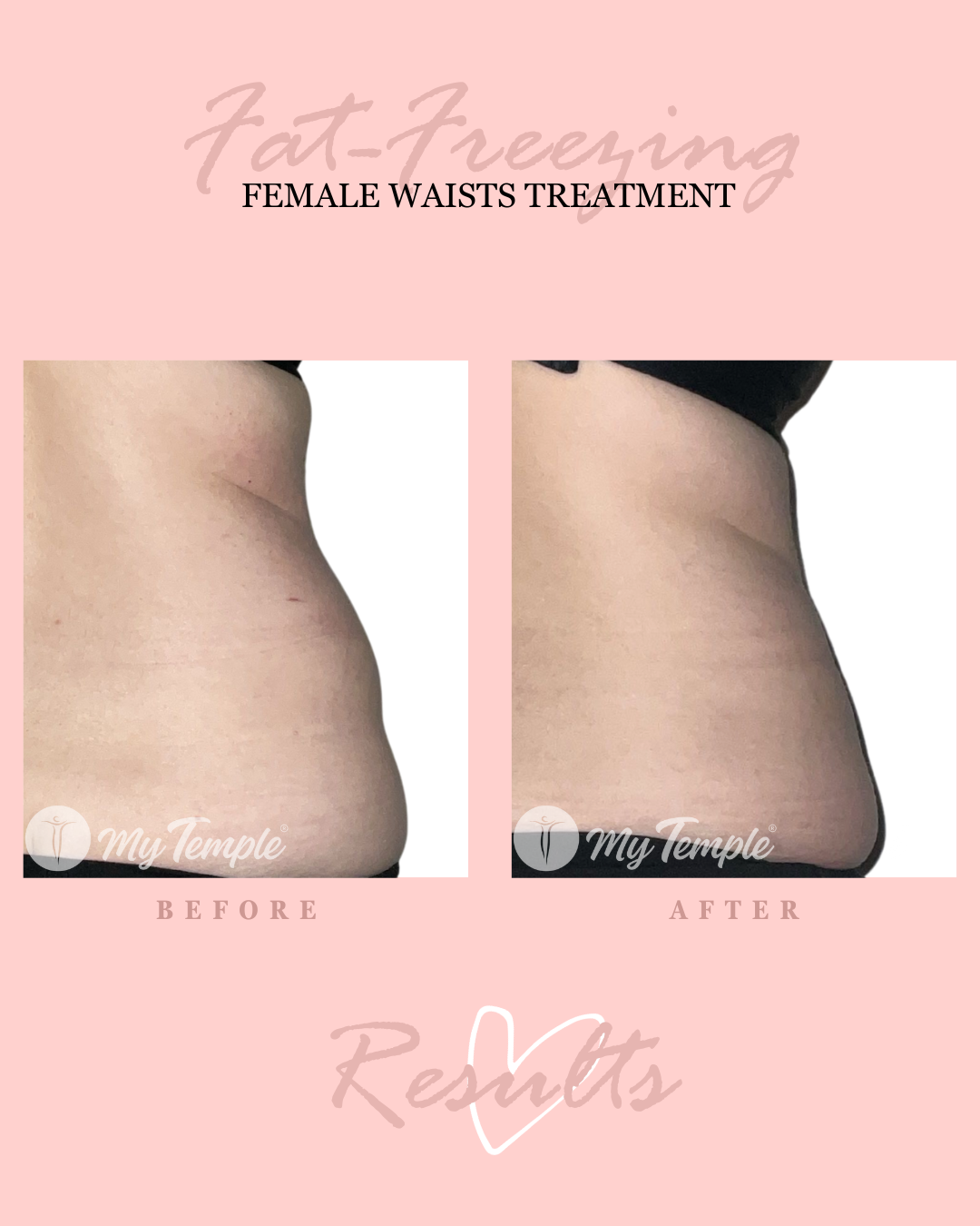 MM abdo waist 25.png