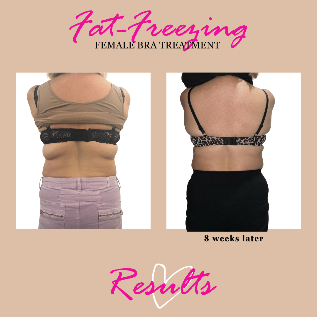 bra line fat freezing result at 8 weeks