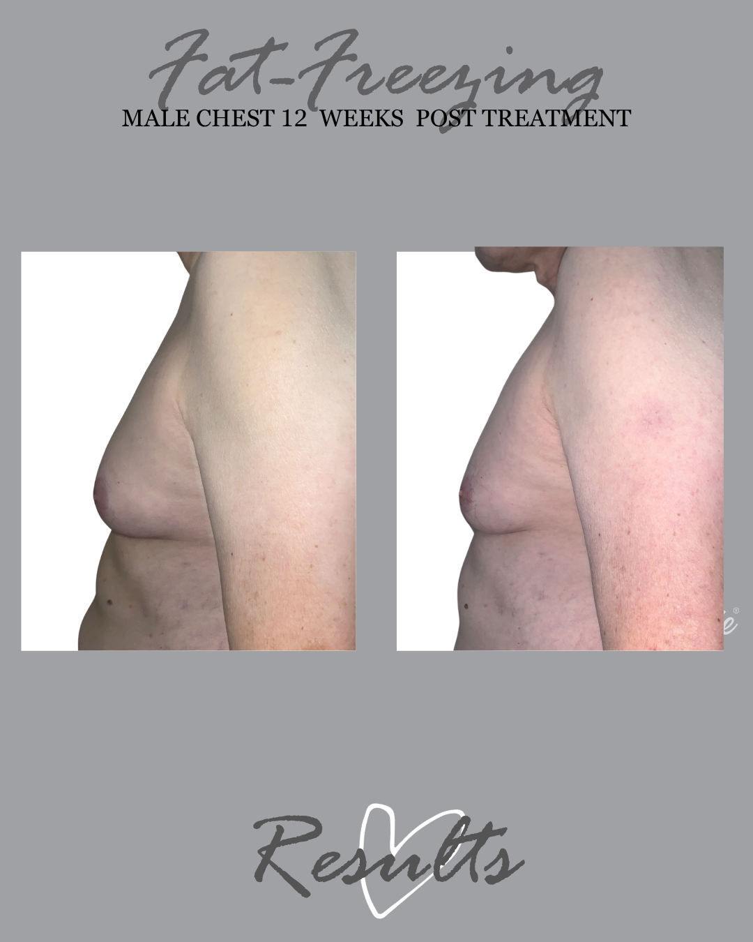 male chest fat freezing result