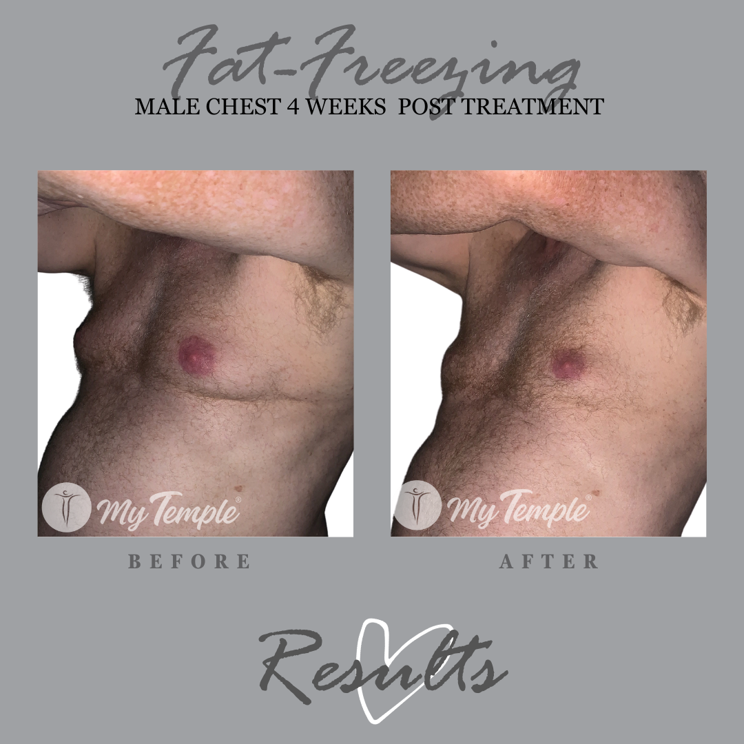 DC chest treatment.png