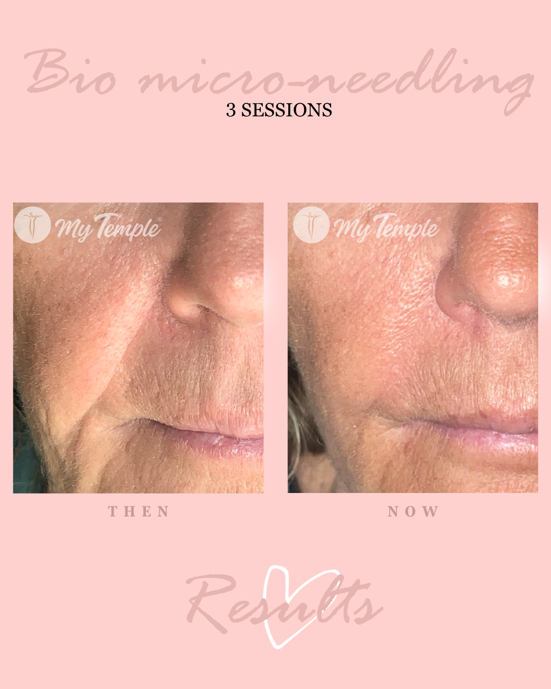 Professional bio microneedling spicule therapy for brighter, firmer, youthful complexion