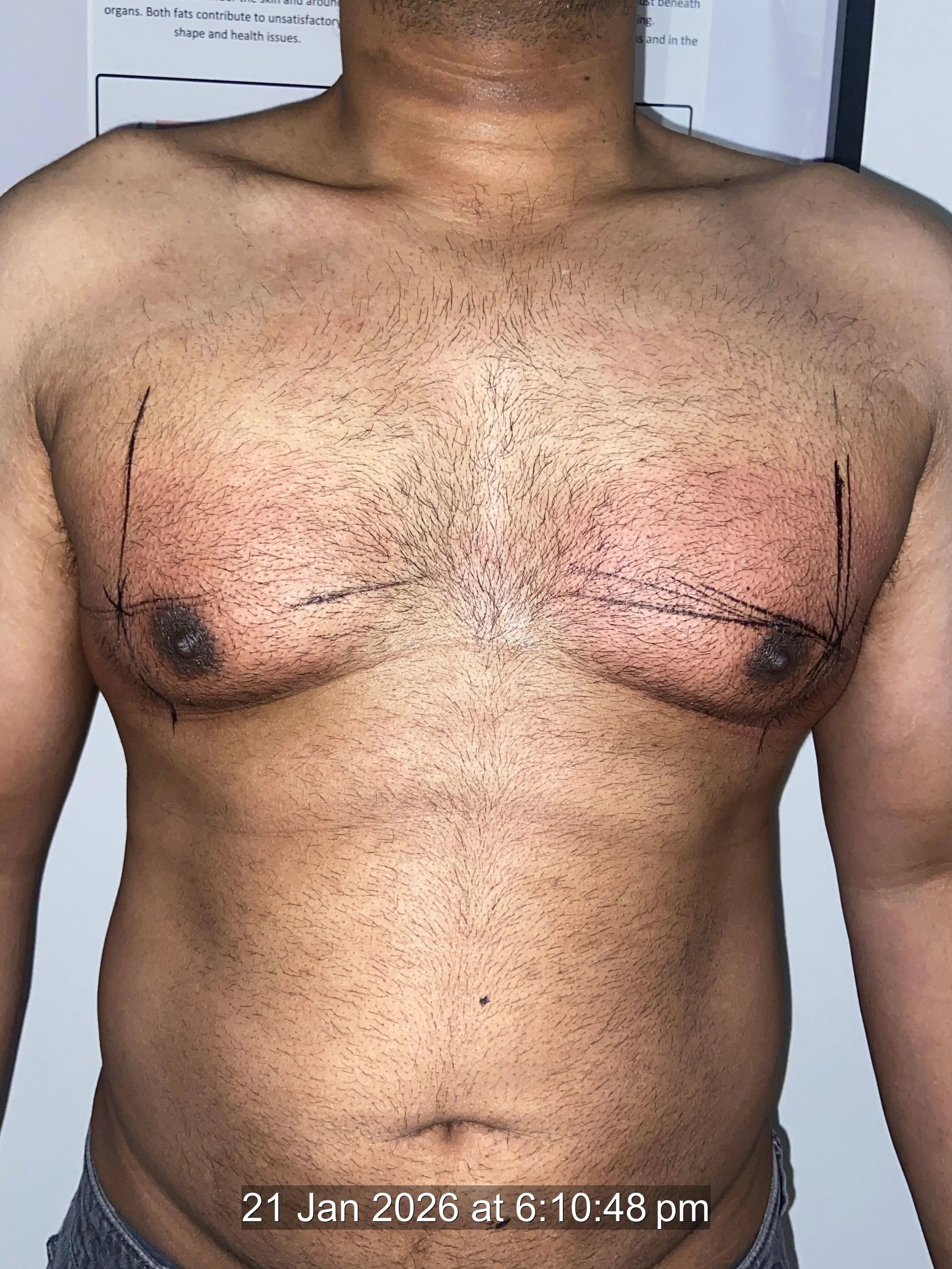area covered mans chest fat freezing