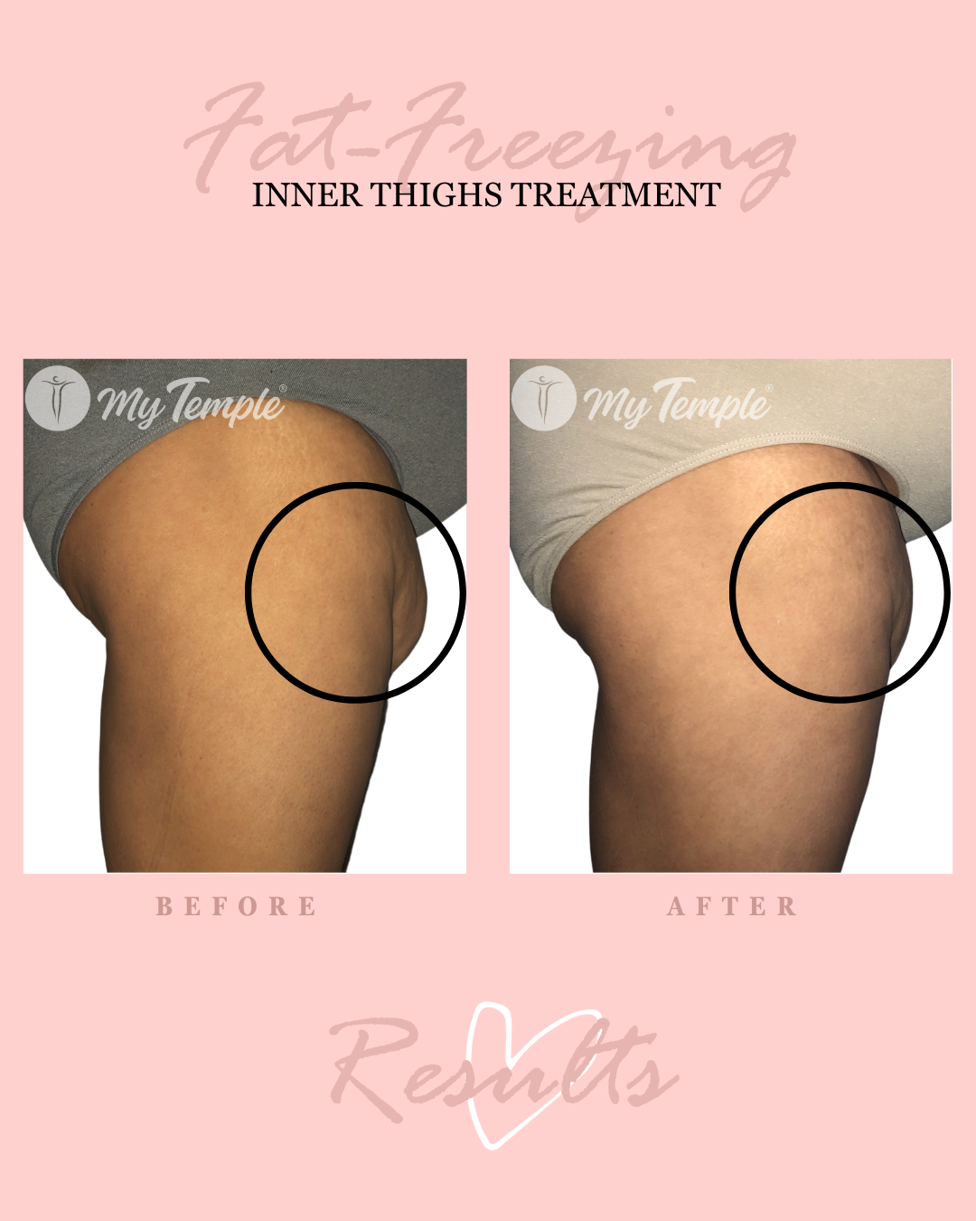 Melvina R (MR) inner thighs 4x5 .png