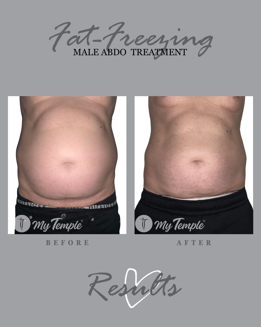 Male abdomen fat freezing results - significantly more contoured shape