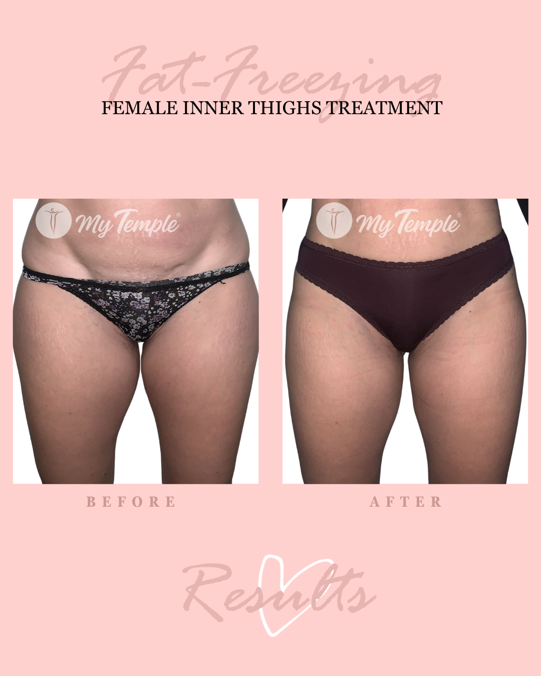 Nadia P inner thighs 4x5.png