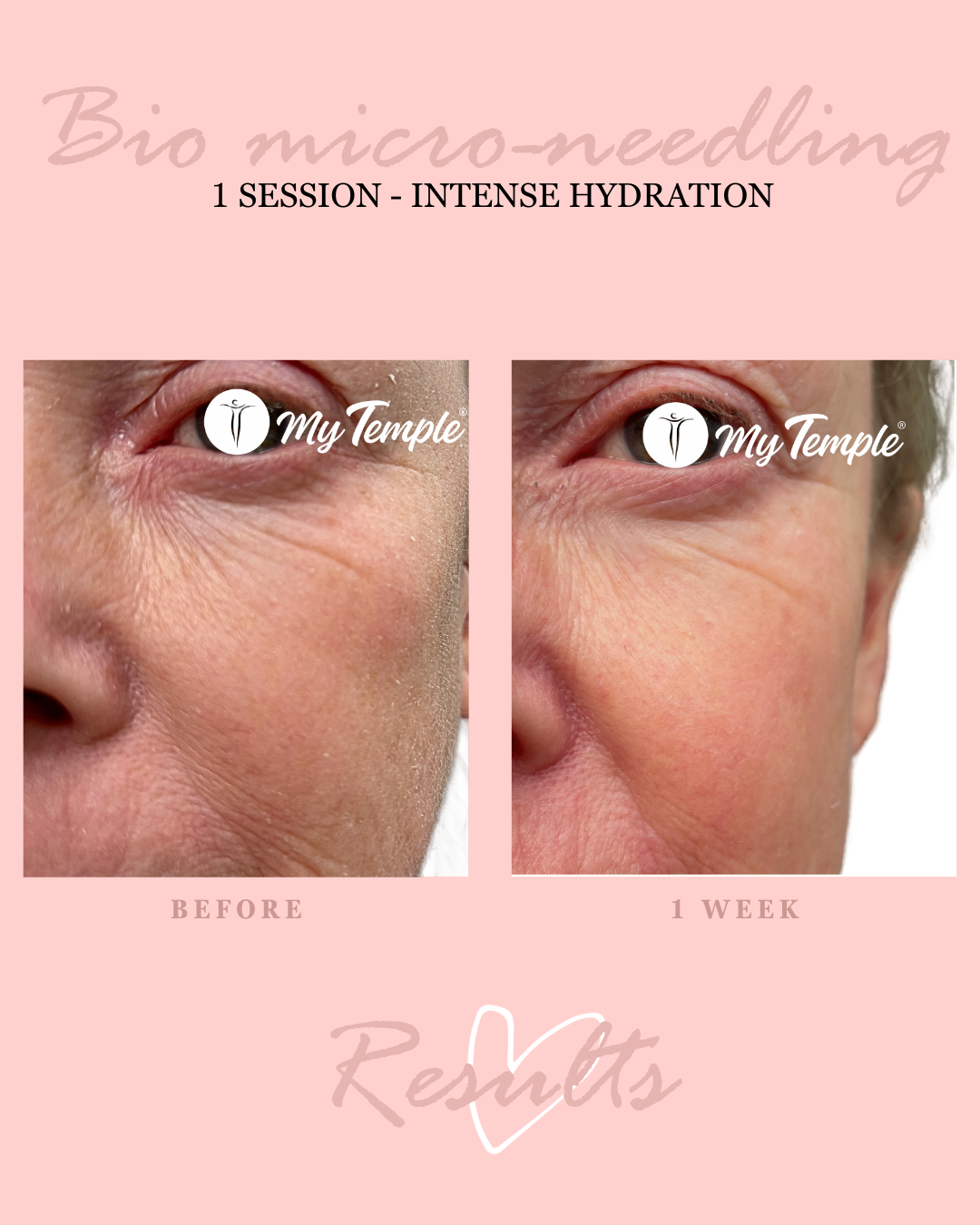 Advanced spicule facial for collagen boosting and skin rejuvenation