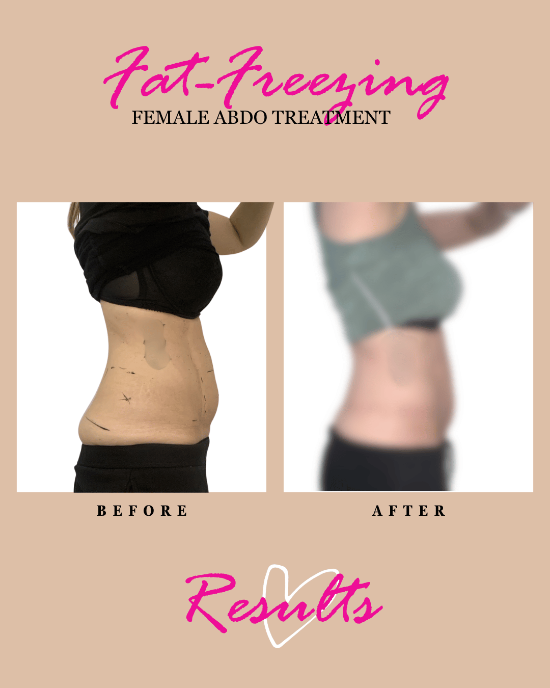 Fat freezing on womens tummy