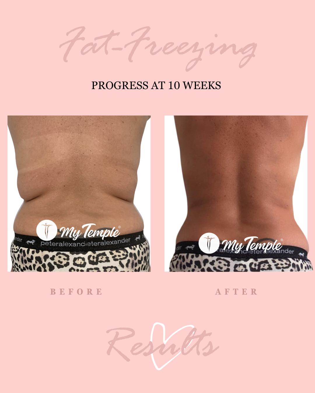 Fat Freezing Result at 10 weeks