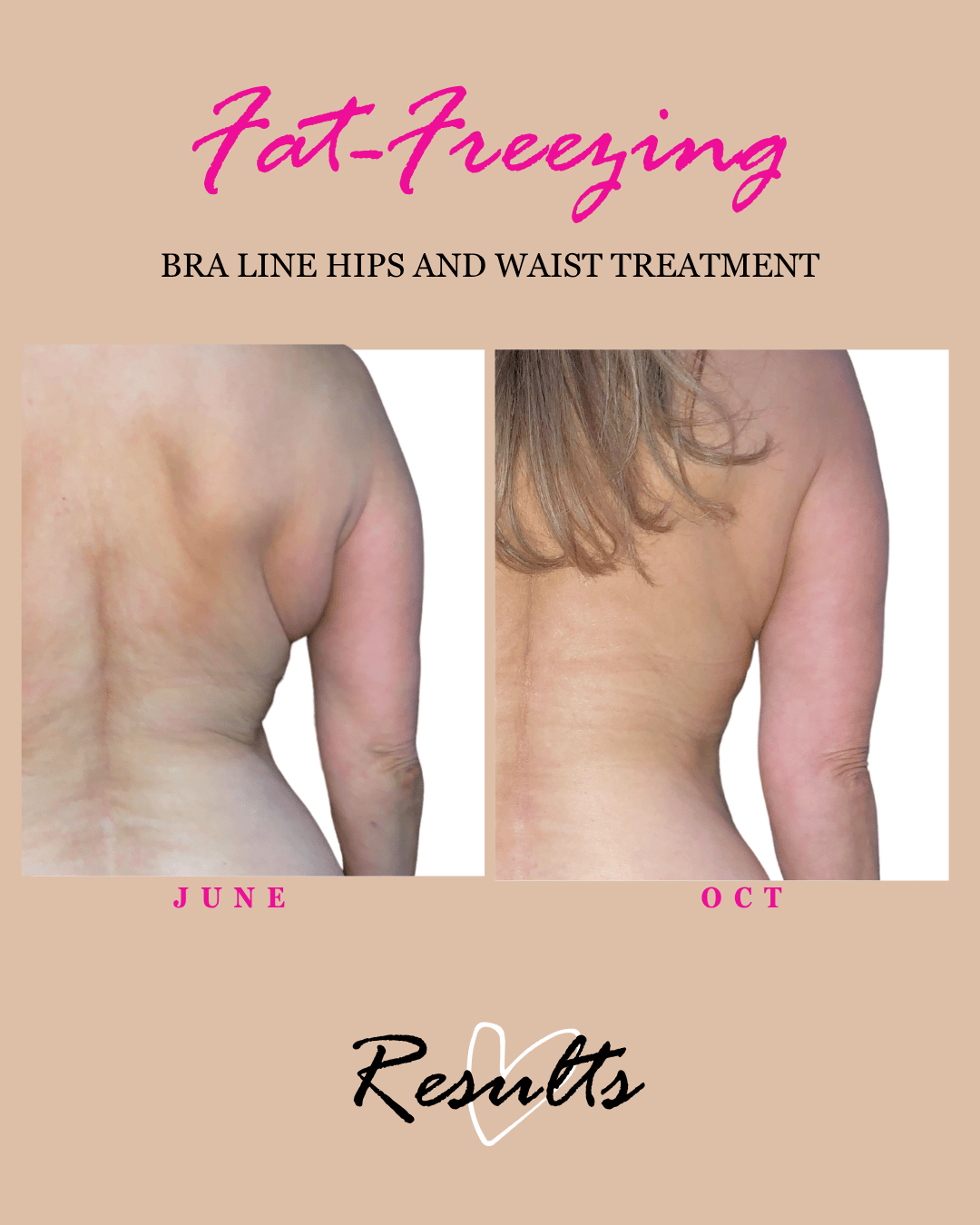 womens bra fat freezing