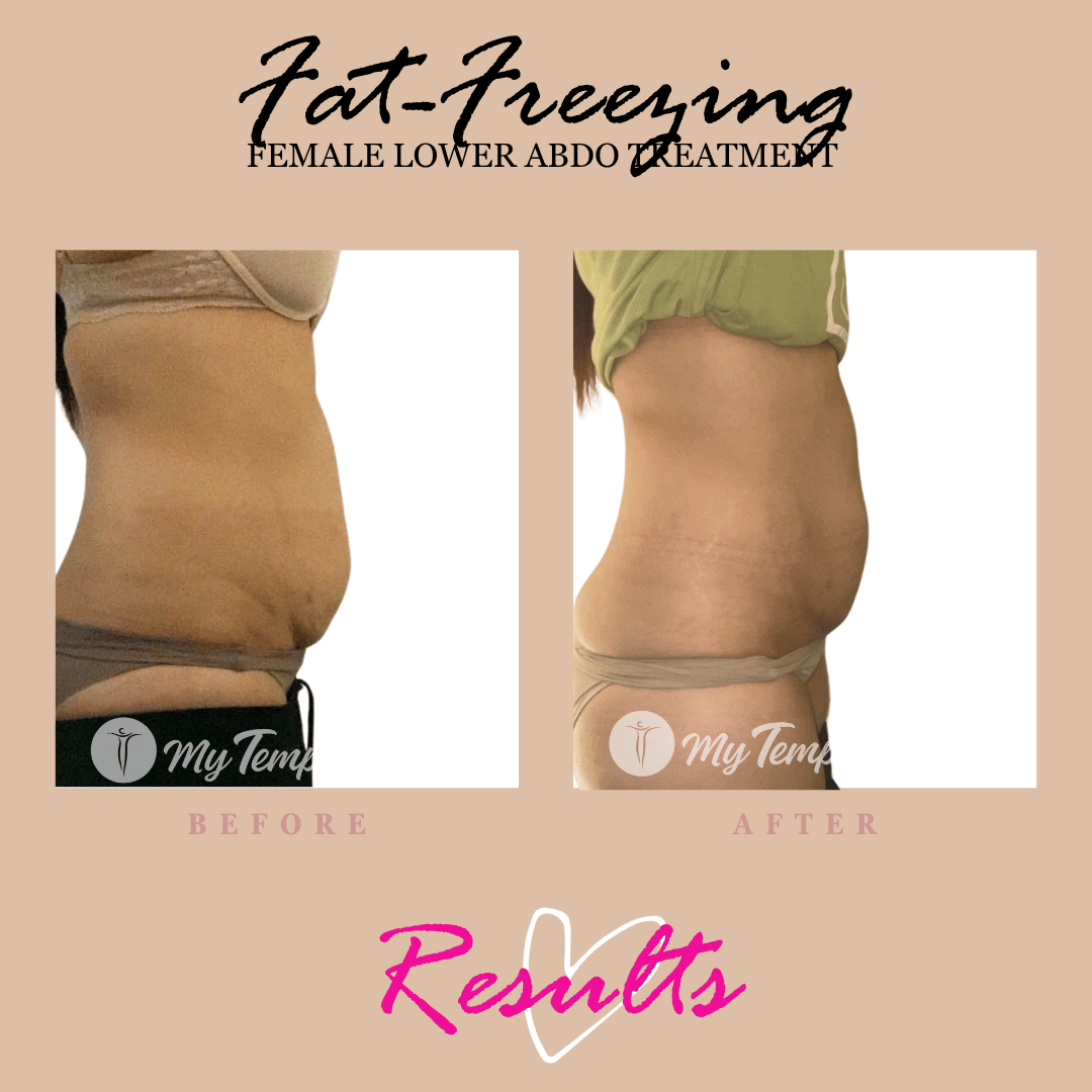 fat freezing on womens abdomen result