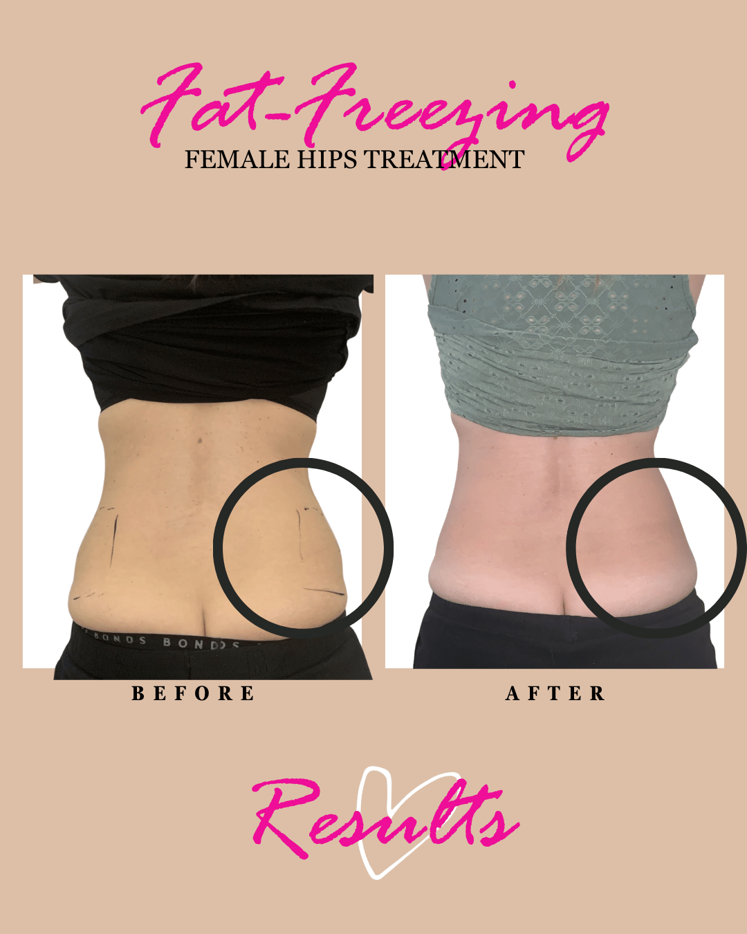 Hips fat freezing on women
