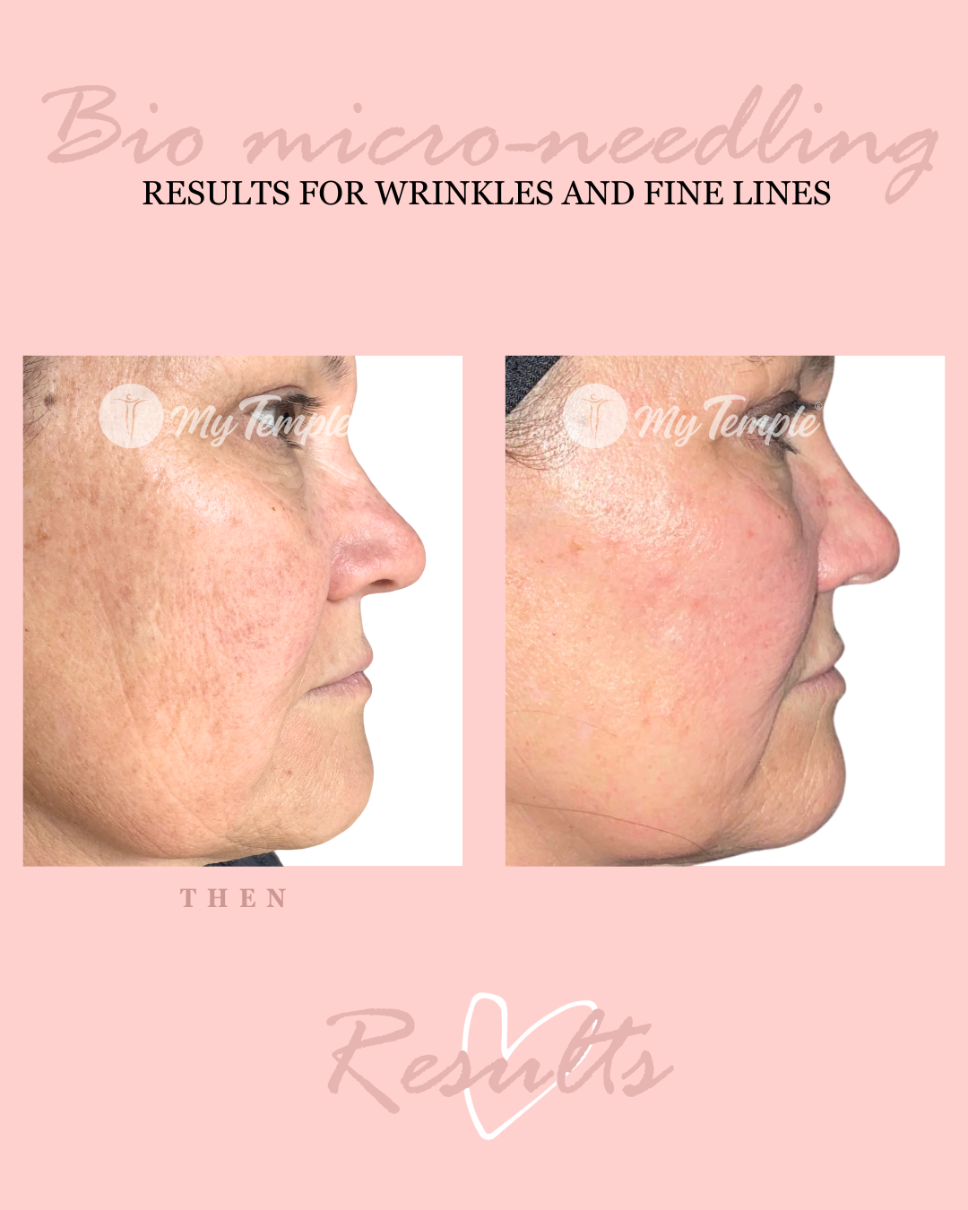 Bio microneedling facial improving wrinkles, sun spots, and uneven skin tone