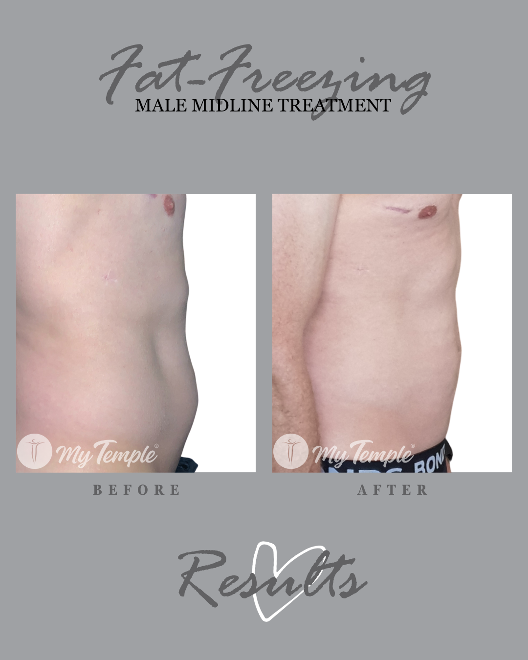 Permanent fat reduction without surgery – before and after