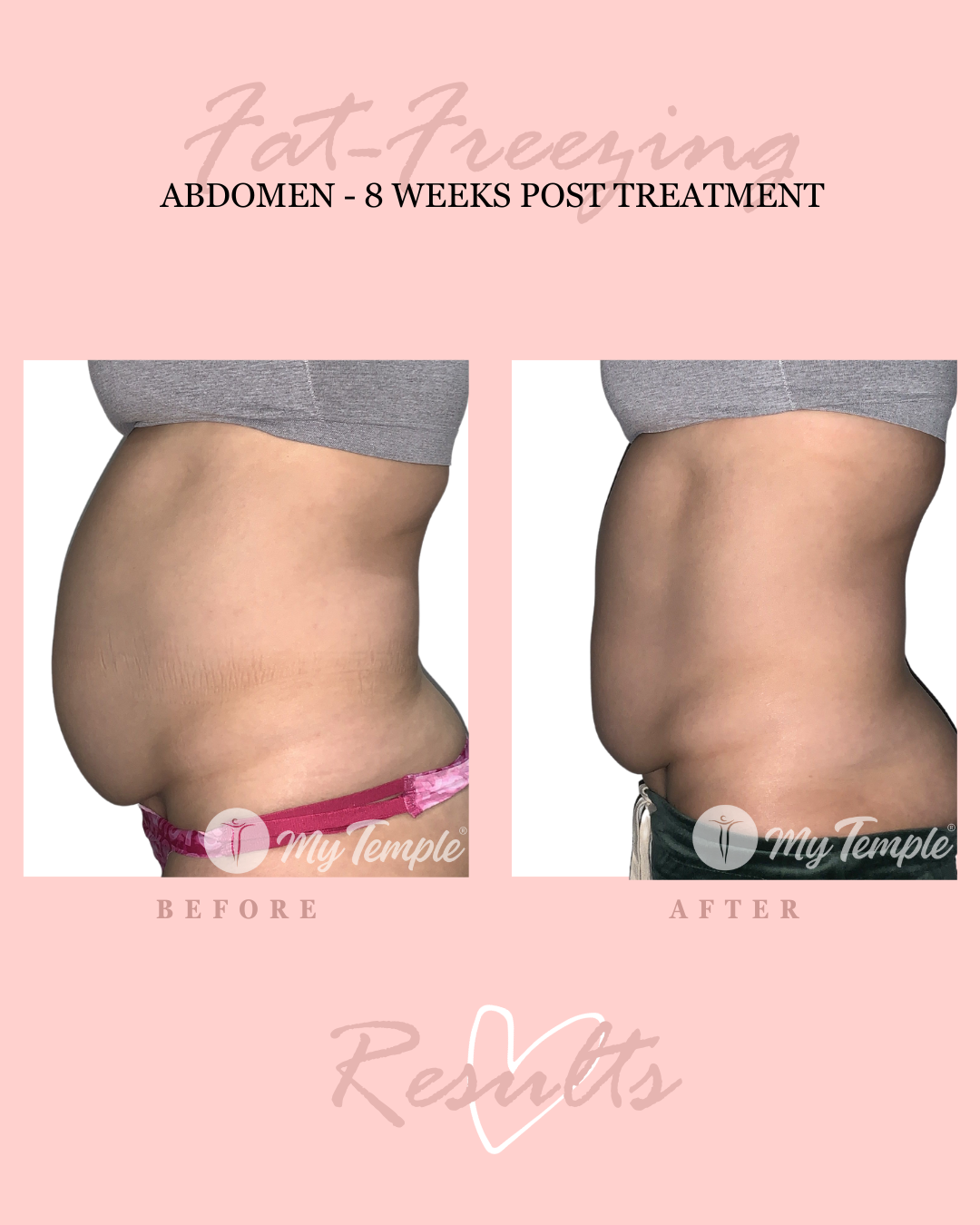 Fat freezing before and after results on female abdomen