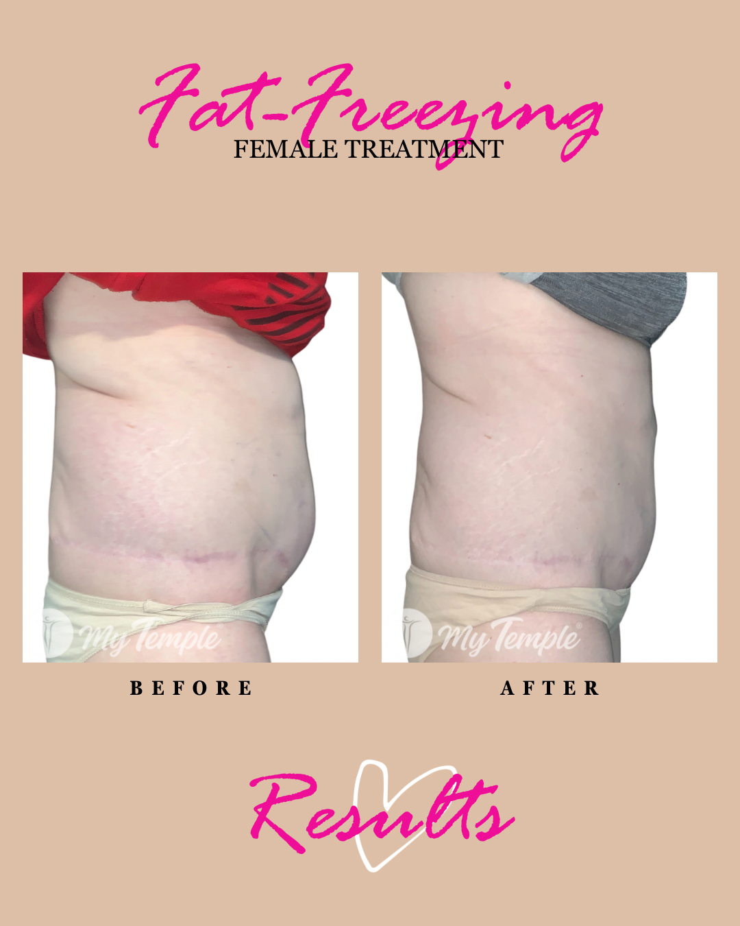 Andrea tummy tuck Abdominoplasty - 3.png
