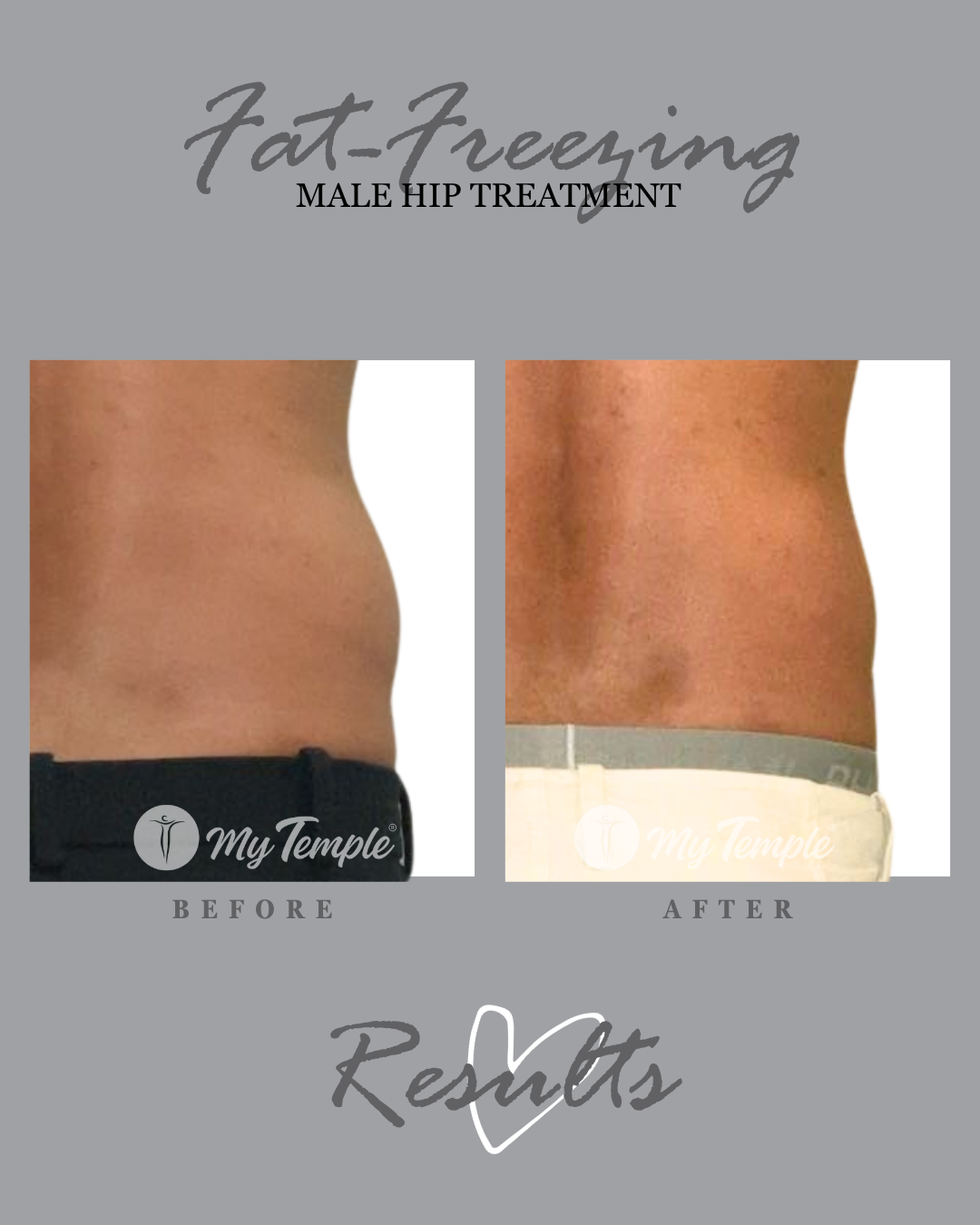 Fat freezing results: male hip, close-up before and after.