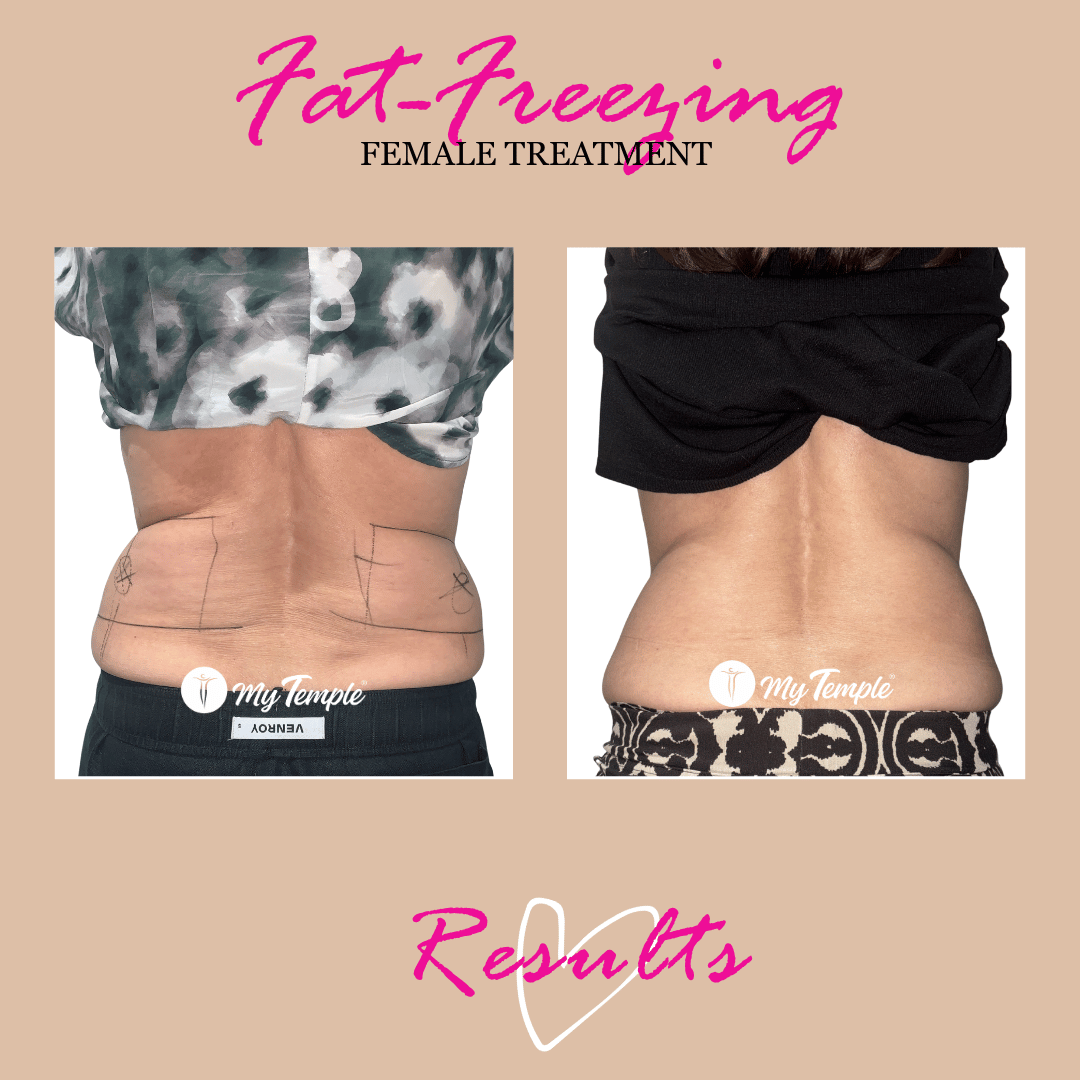 Fat freezing before-and-after comparison of the hips and lower back, August 2023 to June 2025.