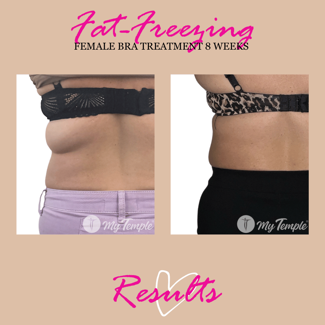bra line fat freezing results  at 8 weeks 