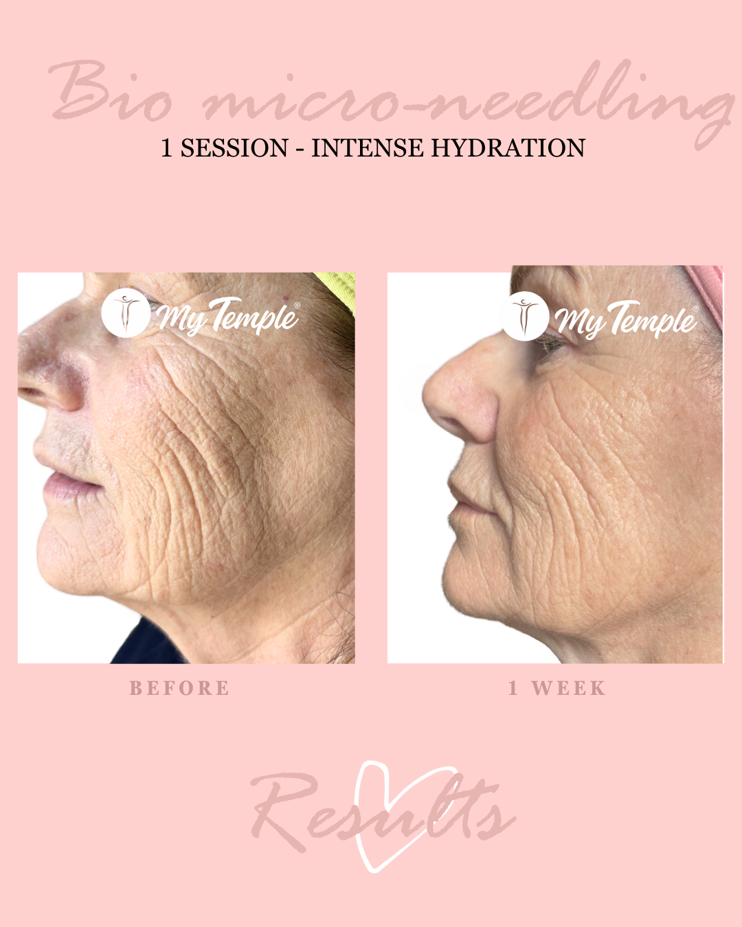 Natural skin resurfacing with biodegradable spicules for smoother texture