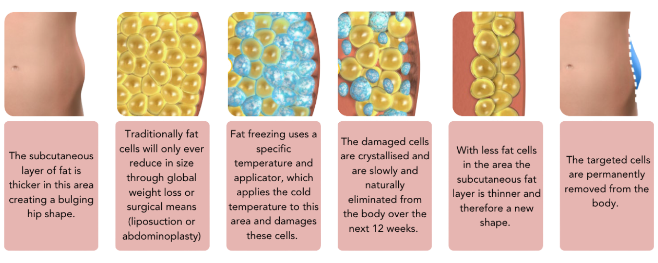 Lower Belly Fat Freezing Flash Sale – $499 for a Limited Time