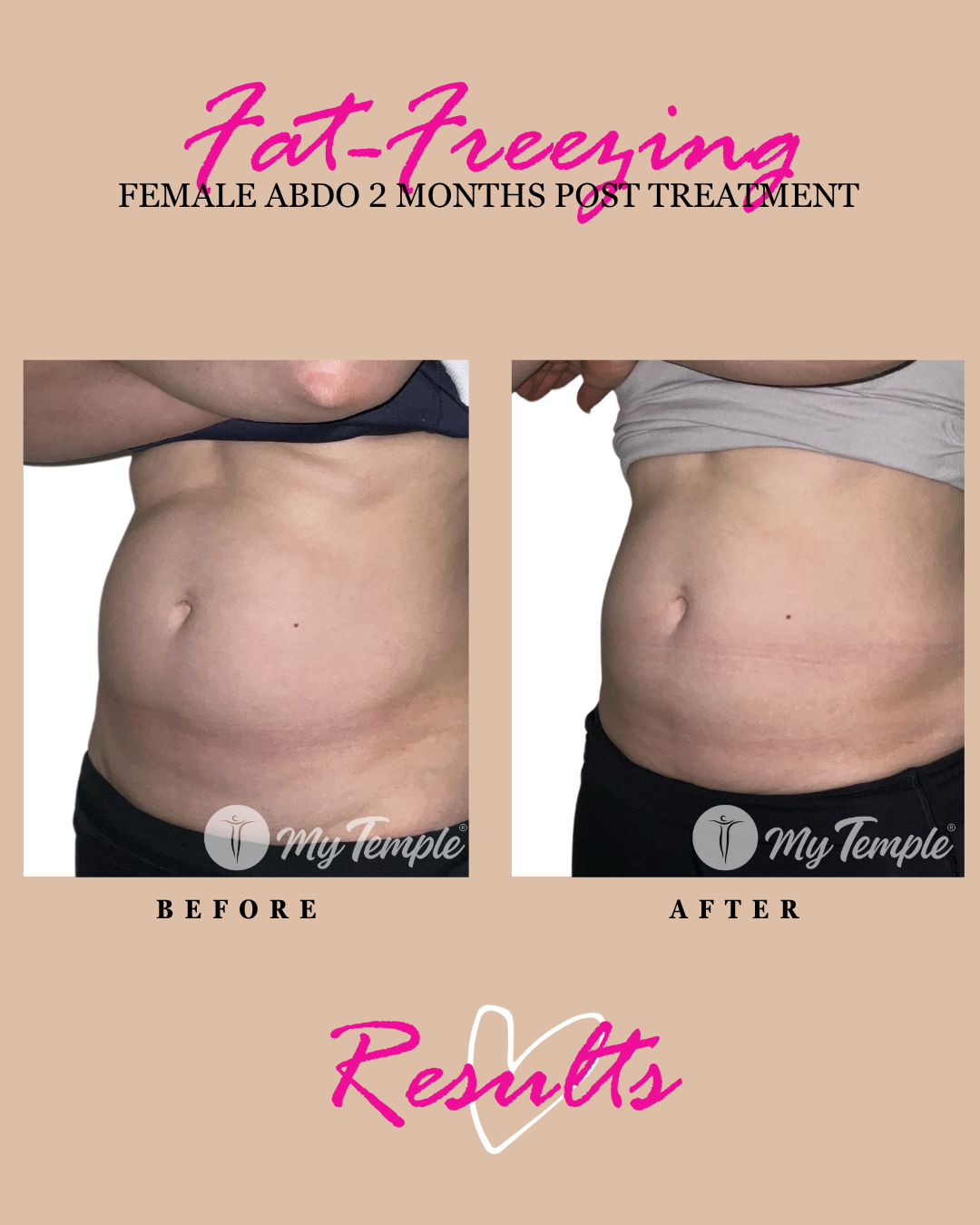 Fat freezing results: female abdomen, close-up before and after.