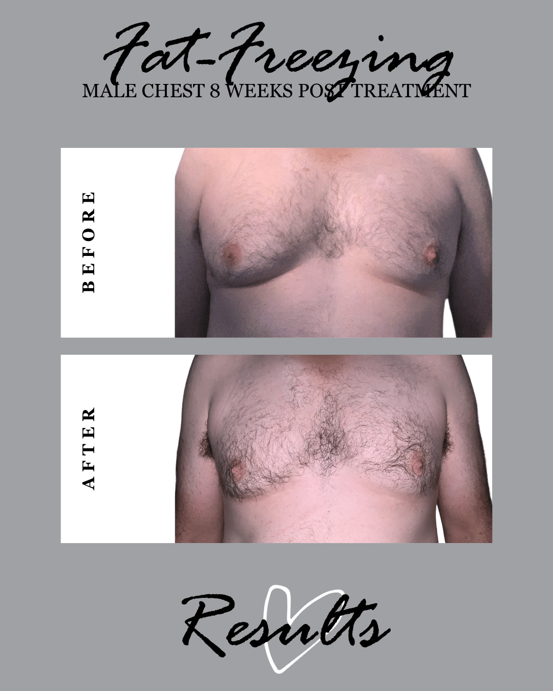 chest fat freezing