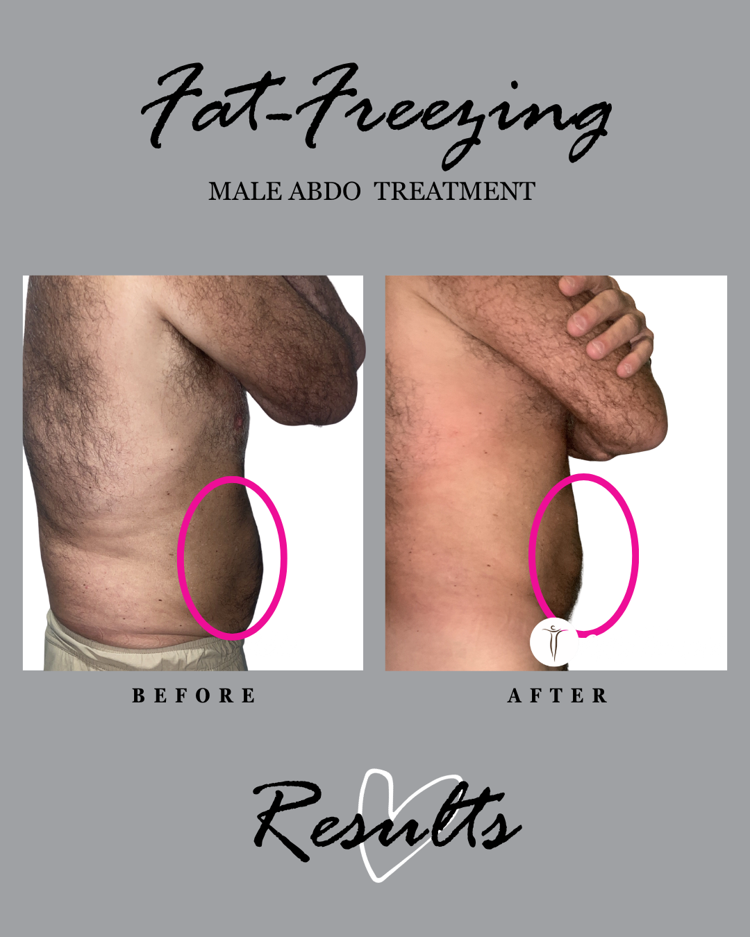 Fat freezing results: male abdomen, side profile before and after.