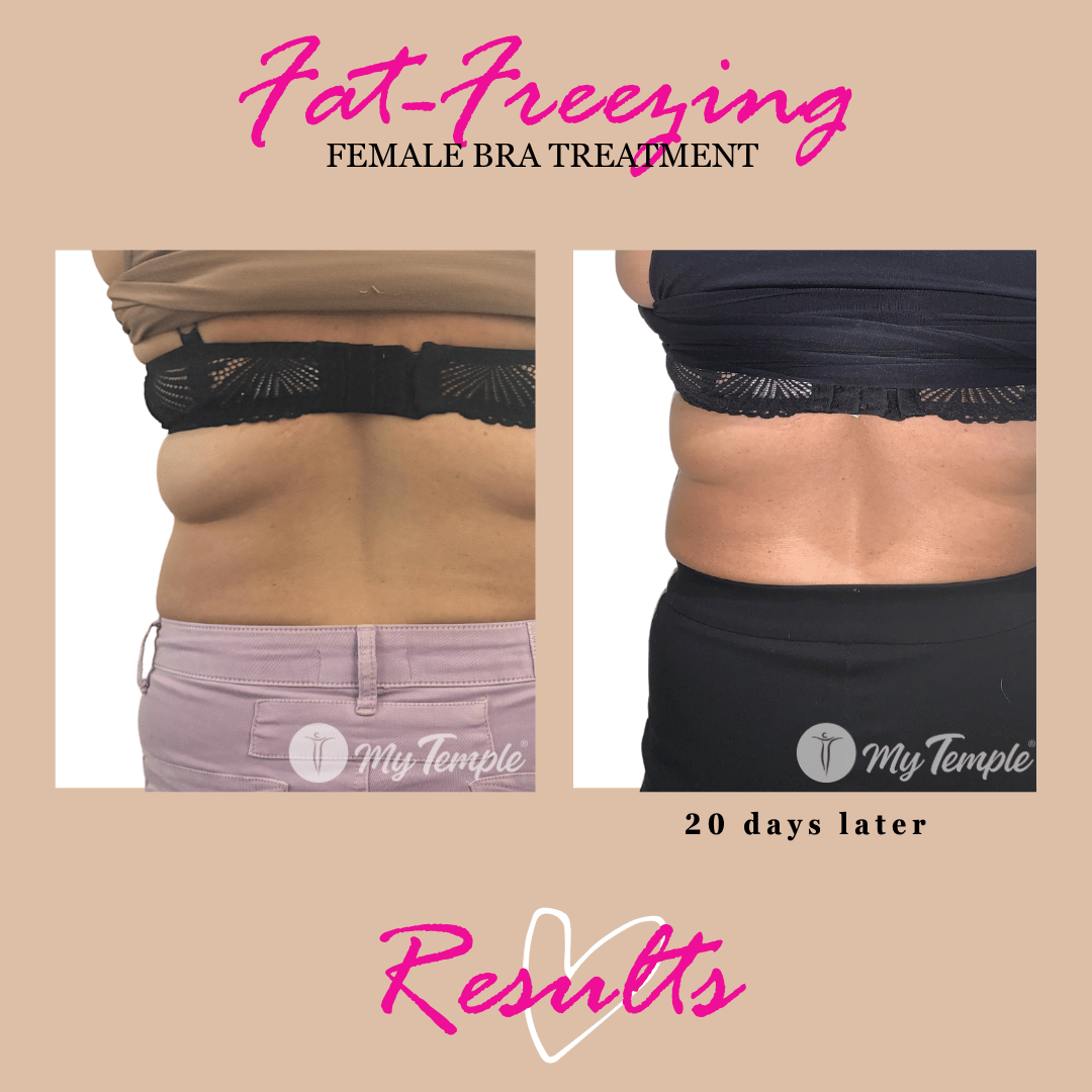 bra line fat freezing results  at 3 weeks