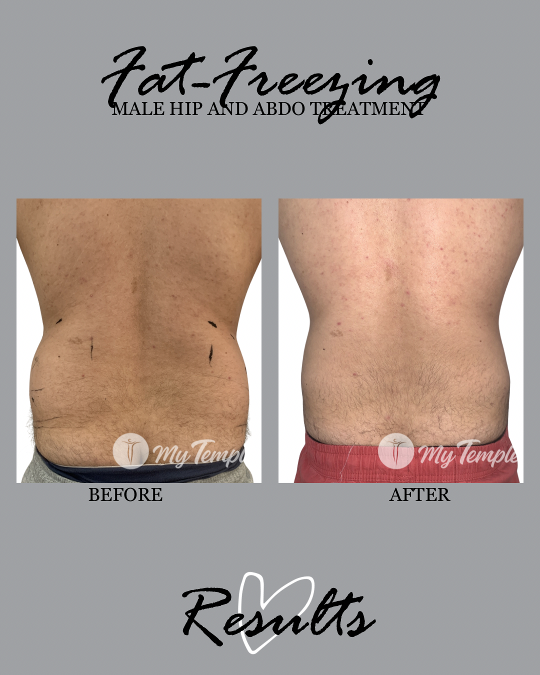 FAT FREEZING RESULTS  ON MENS HIPS