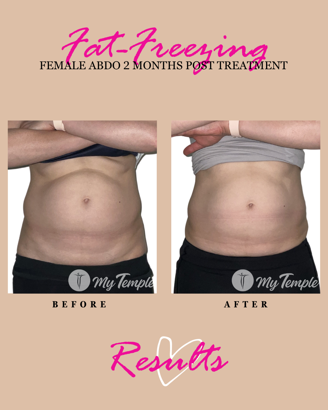 Fat freezing results: female abdomen, 2 months post treatment.
