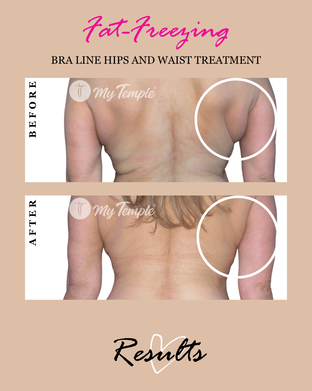 womens bra fat freezing