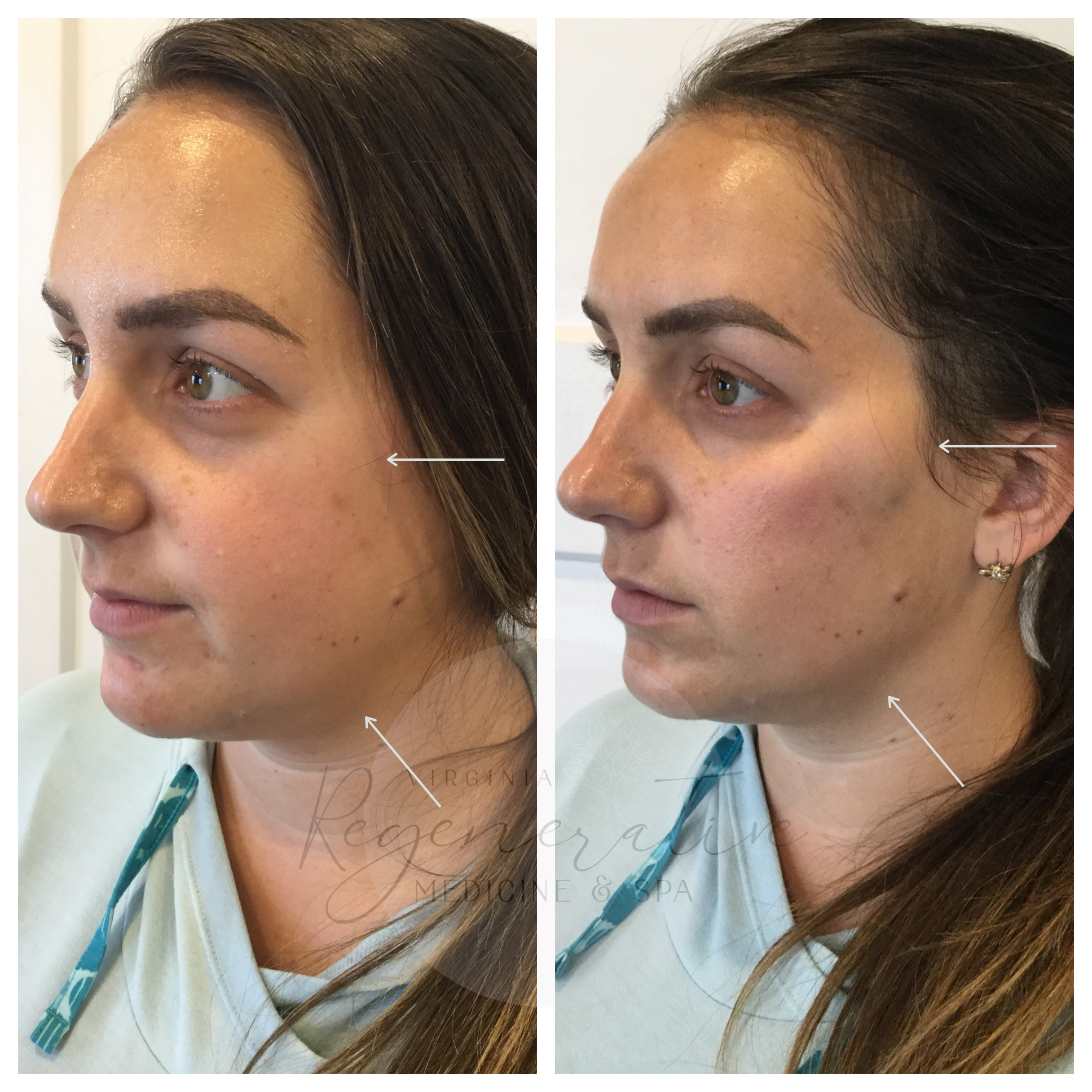 Versa Cheek Filler - Helped Appearance of Jaw Contour