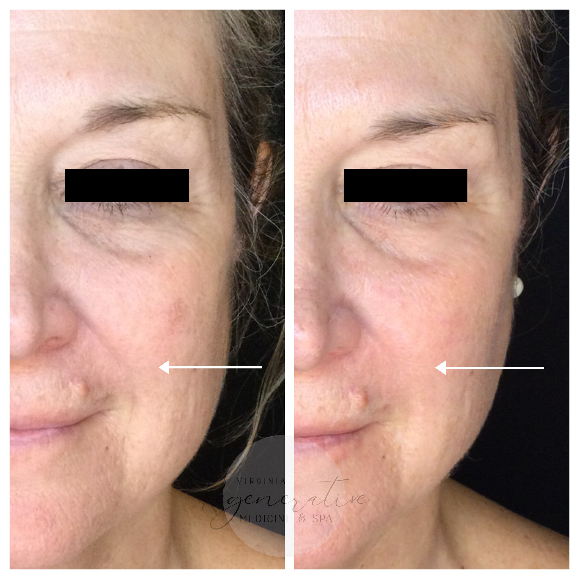 Microneedling with Exosomes 2 Weeks Before and After
