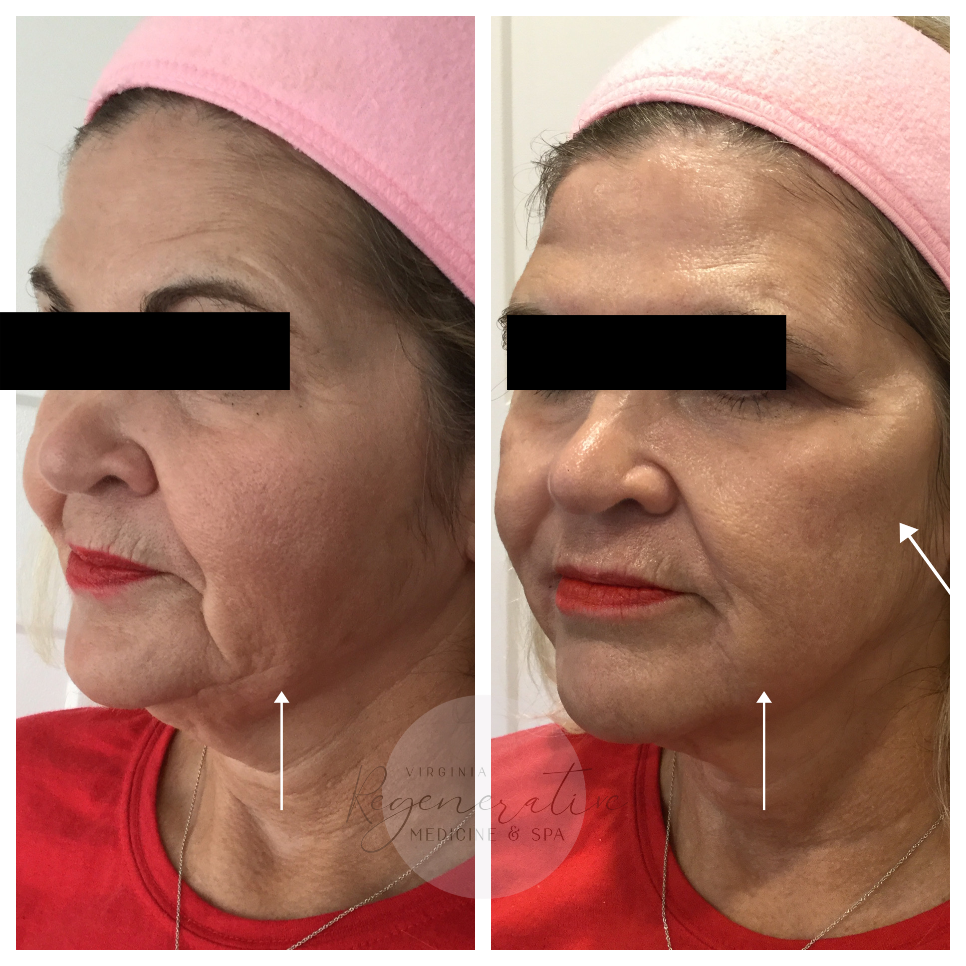 Belotero and Radiesse Immediately Before and After