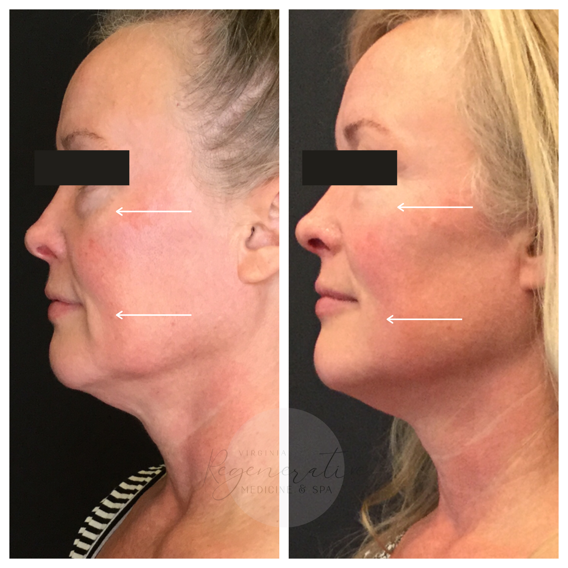 Belotero Under Eye and Microneedling