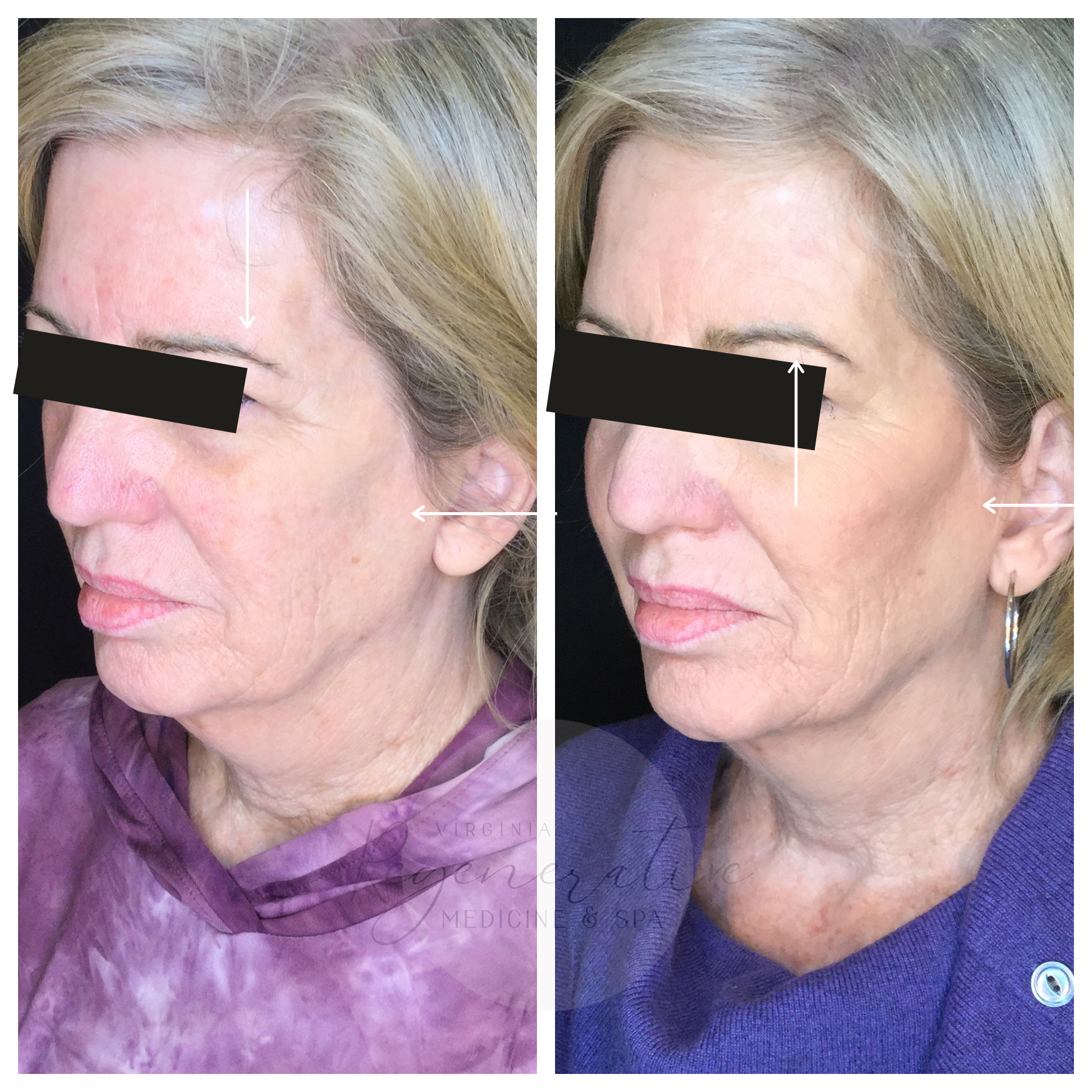  Xeomin Brow &amp; Cheek | Radiesse Filler  