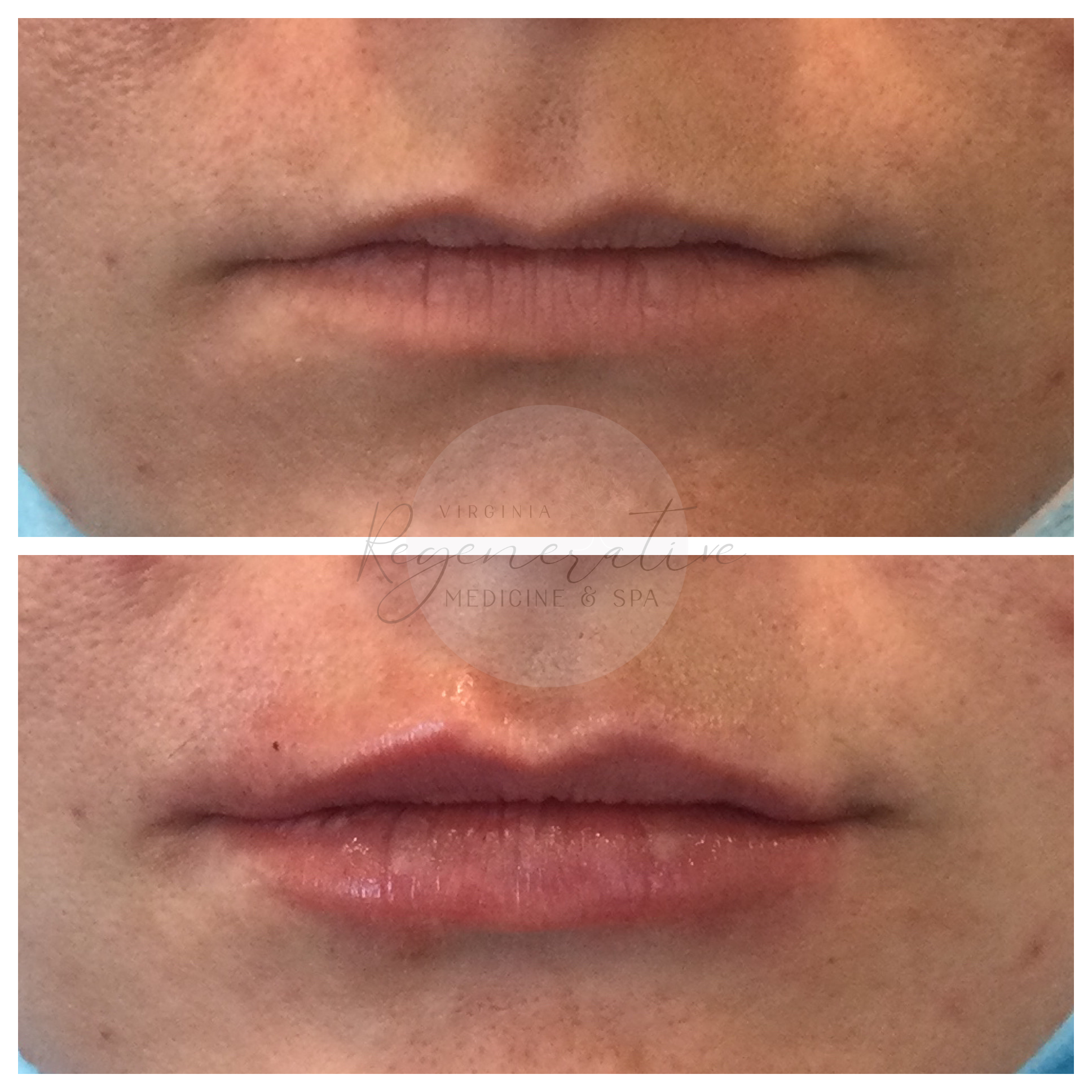 Versa Lip Filler
