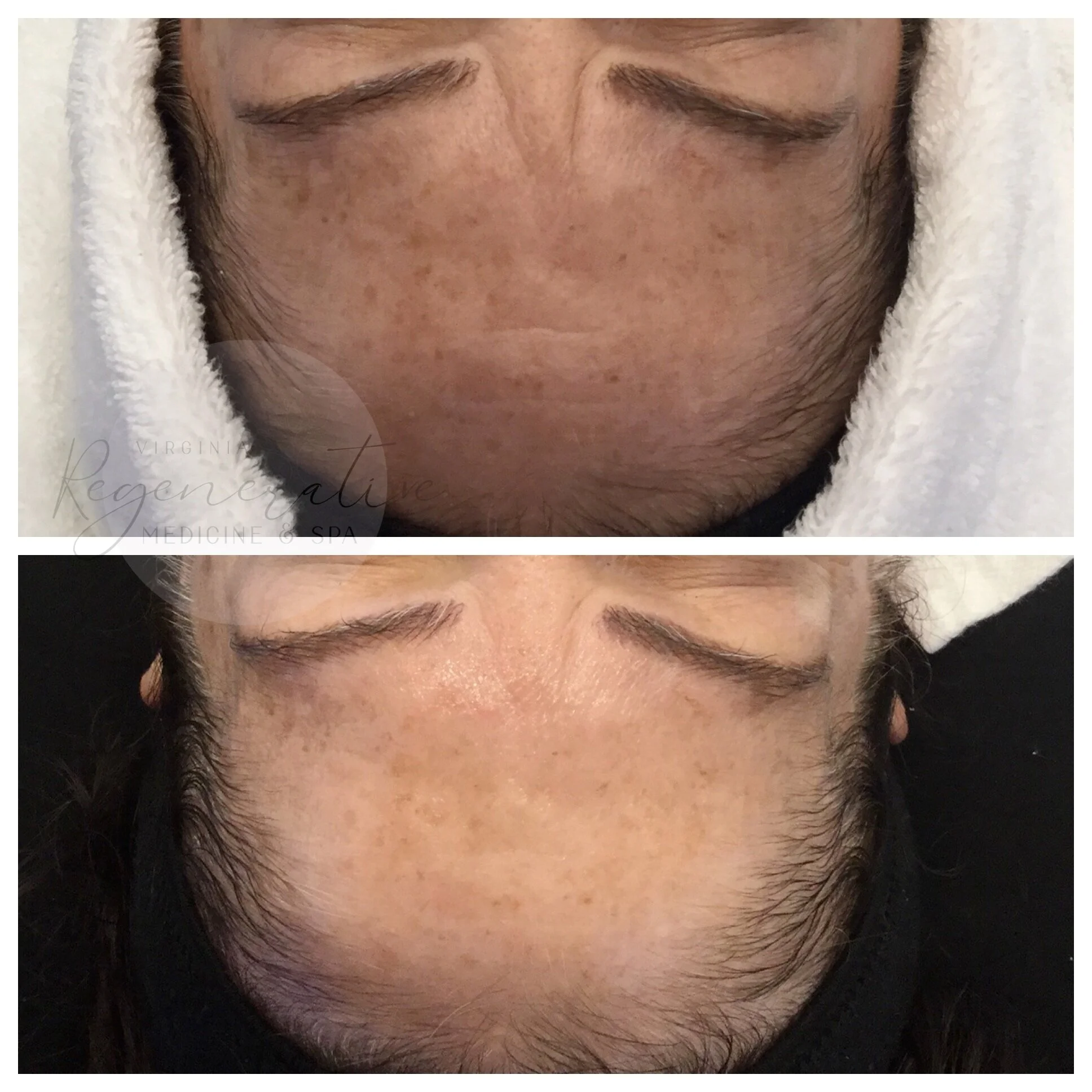 Series of Hydrafacial Brightening Facial