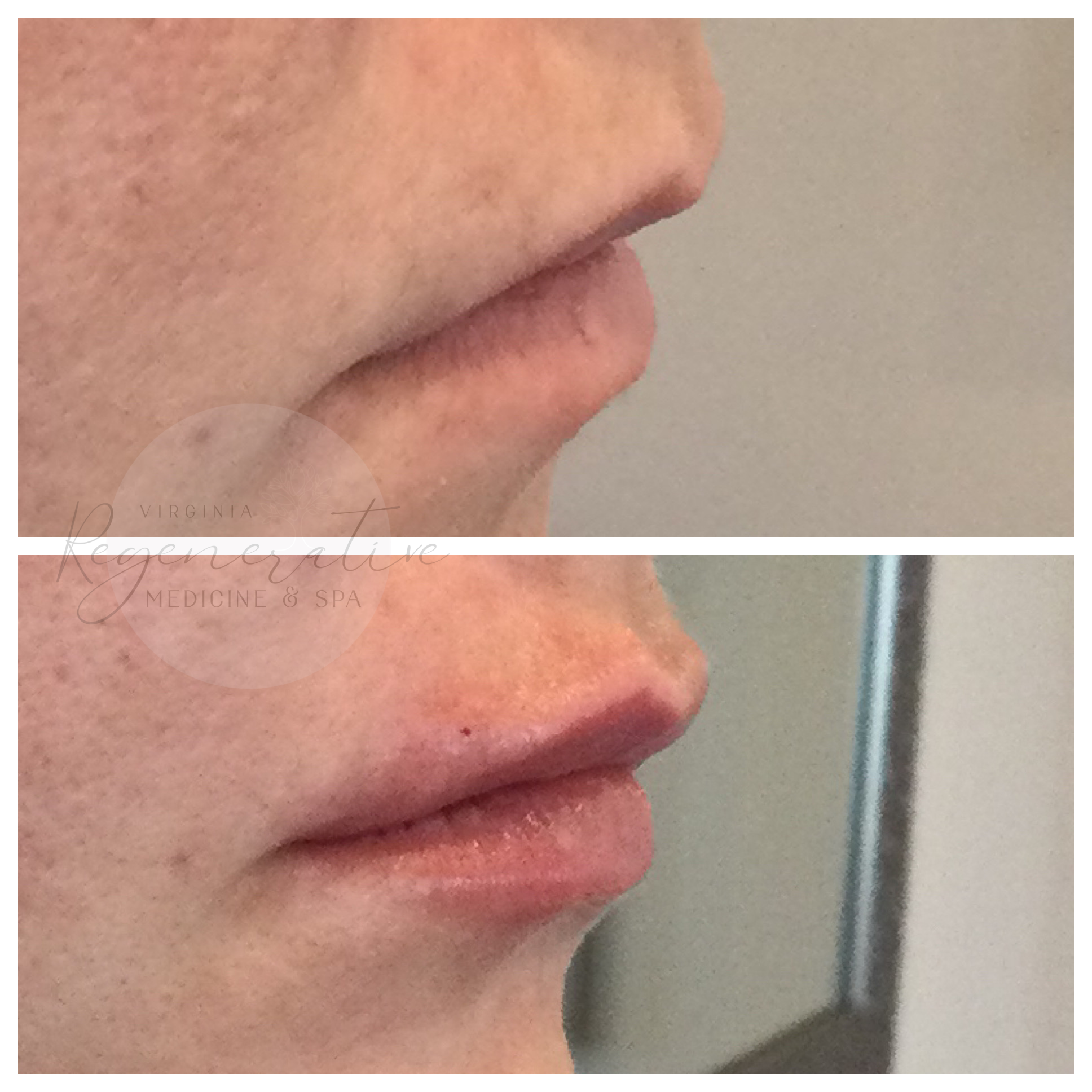 Versa Lip Filler