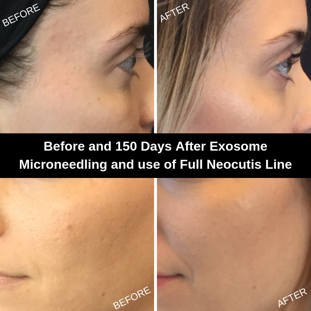 Microneedling, Neocutis 5 months.png