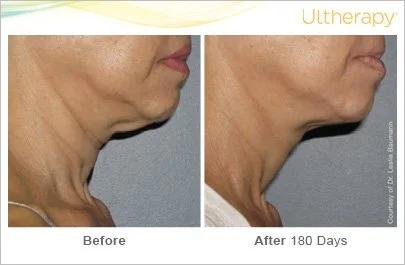 ultherapy_0008-0086w_beforeandafter_180day_1tx_neck2.jpg
