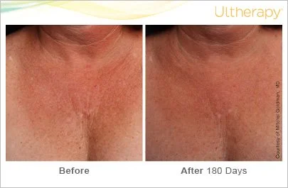 ultherapy_093-011-b-o_beforeandafter-180day_1tx_chest.jpg