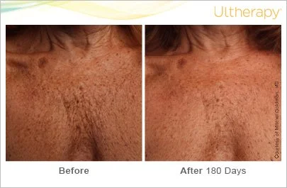 ultherapy_093-014-s-c_beforeandafter-180day_1tx_chest.jpg
