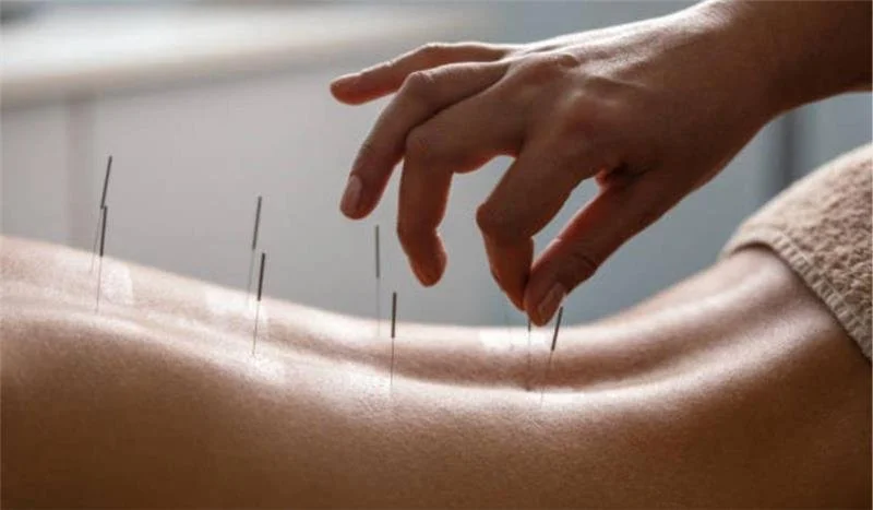 Acupuncture for Detox Support: A Natural Way to Cleanse, Heal, and Restore Balance&nbsp;