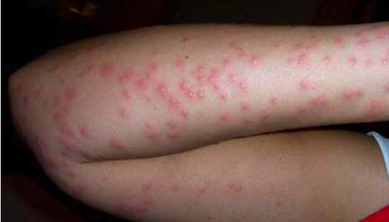 Close-up of a person's leg with numerous red, raised bumps or rashes.