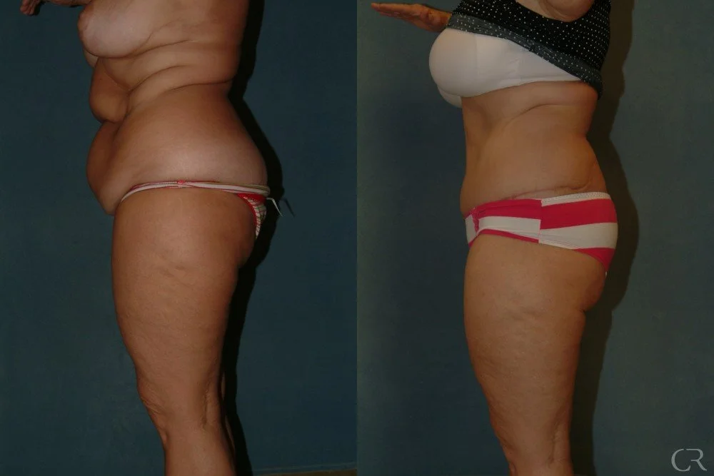 abdominoplasty-1.jpg